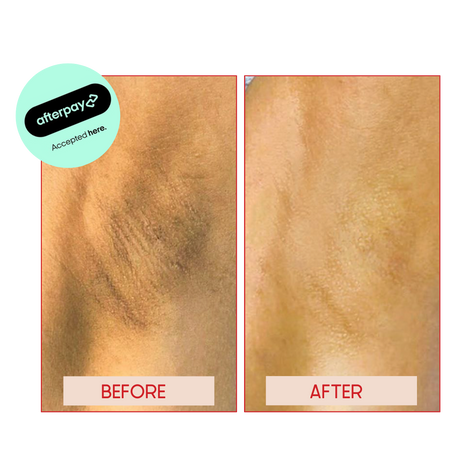 UNDERARM WHITENING near me