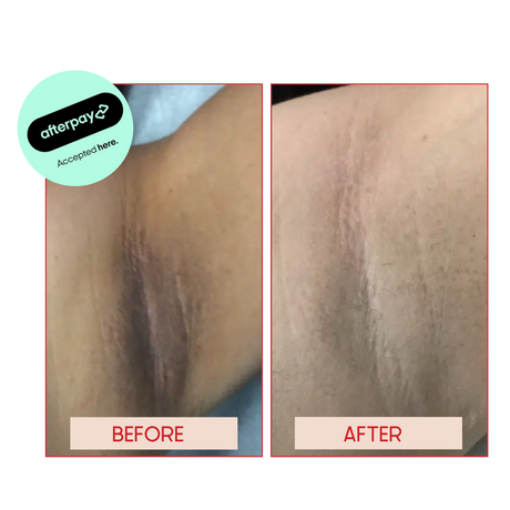 UNDERARM WHITENING SYDNEY