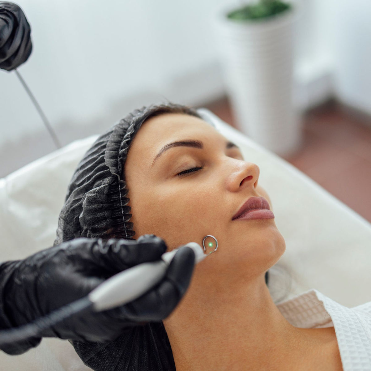 Laser Acne Treatment