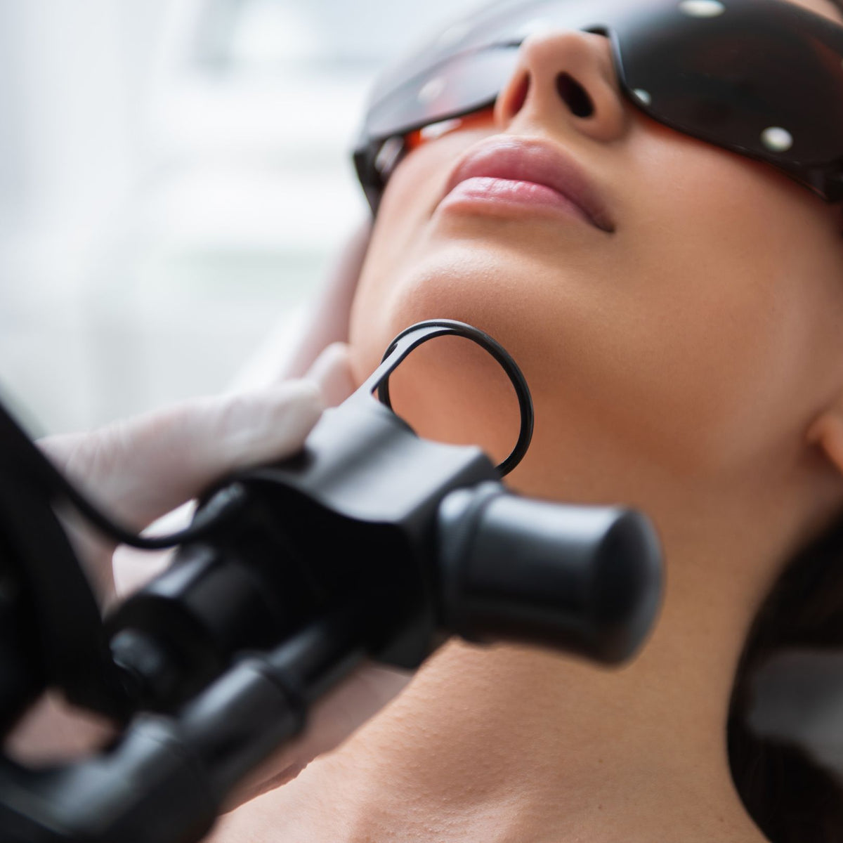 CO2 Laser Treatment