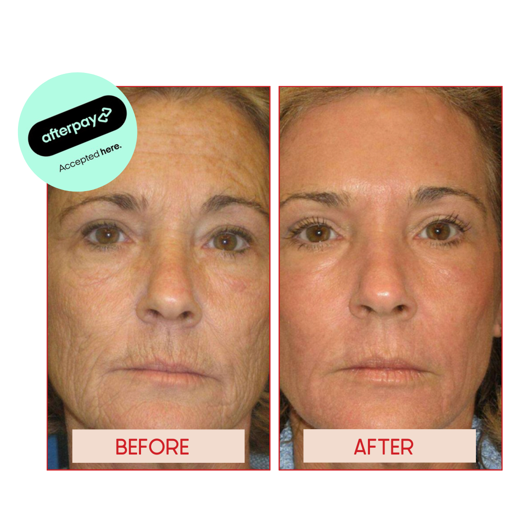 CO2 LASER RESURFACING X2 SESSIONS