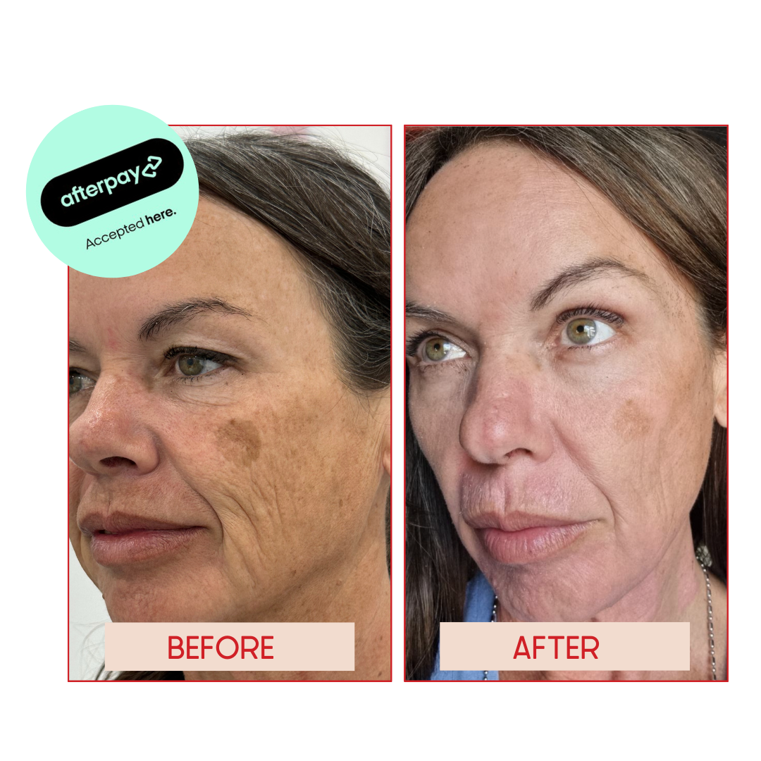 CO2 LASER RESURFACING X1 SESSION