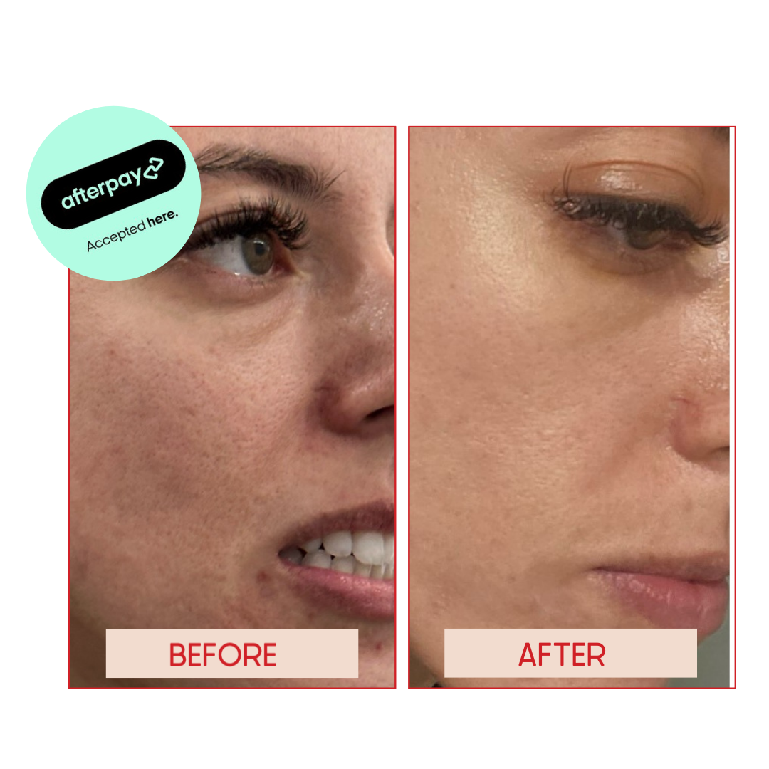 CO2 LASER RESURFACING X3 SESSIONS