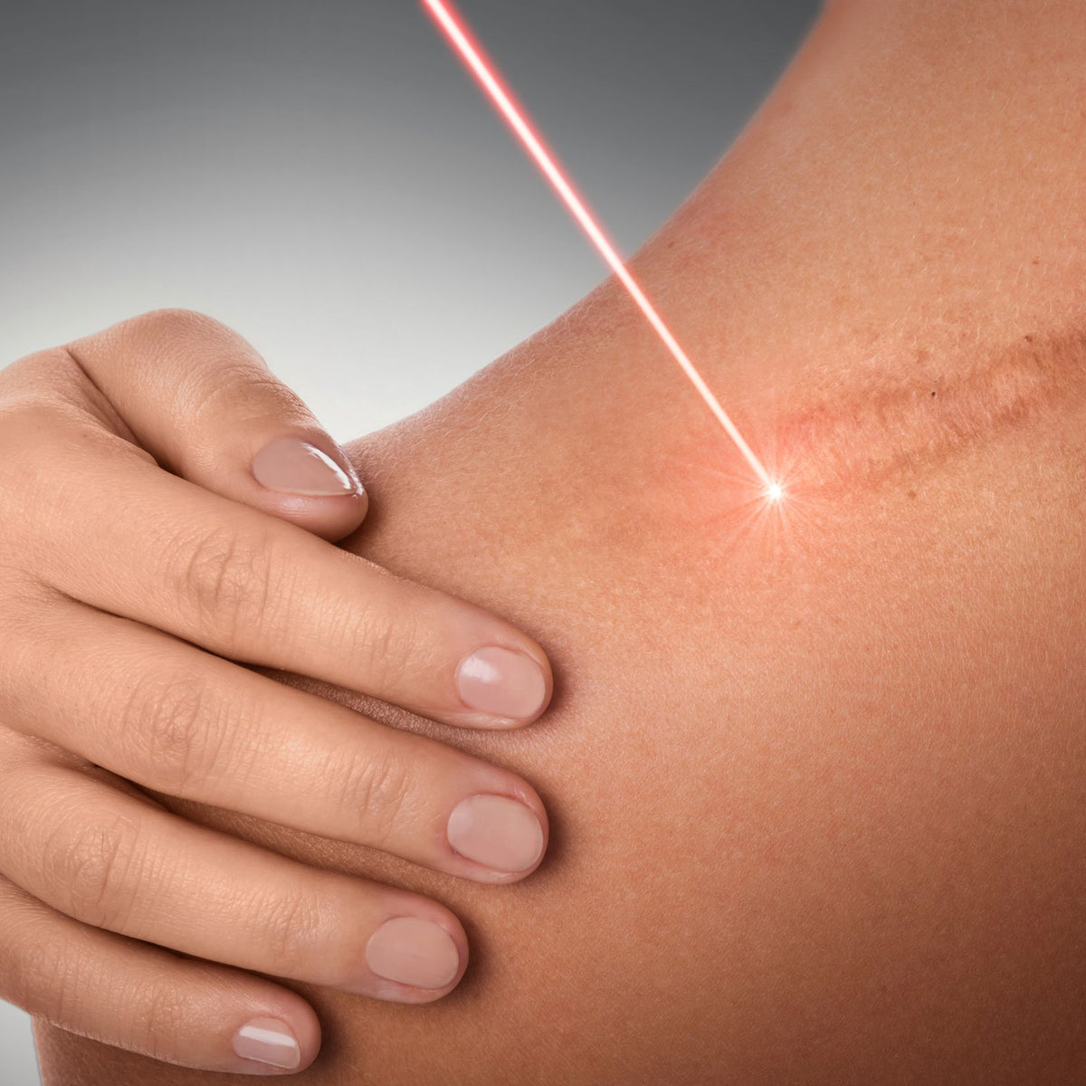 CO2 Laser Treatment