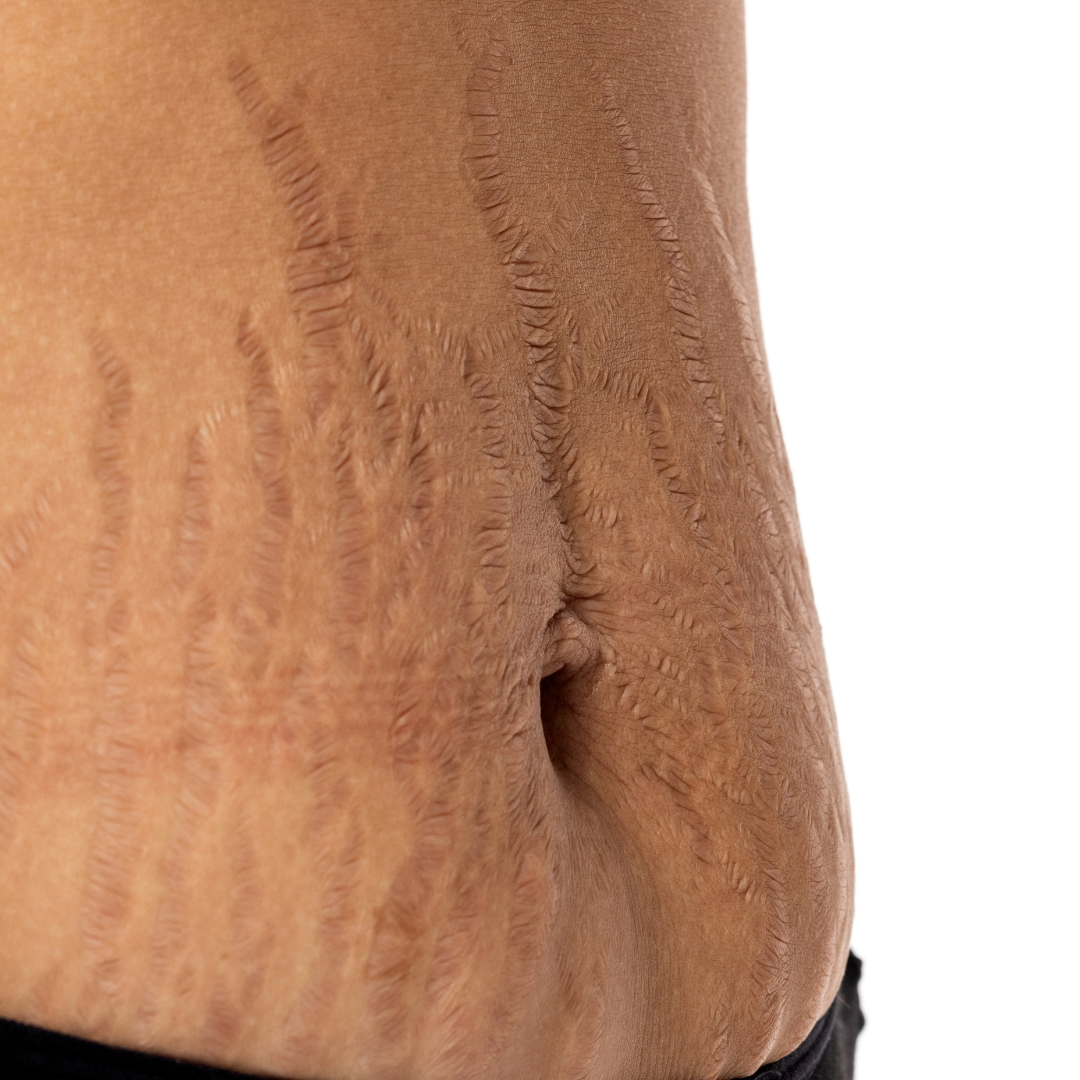 CO2 Laser Treatment