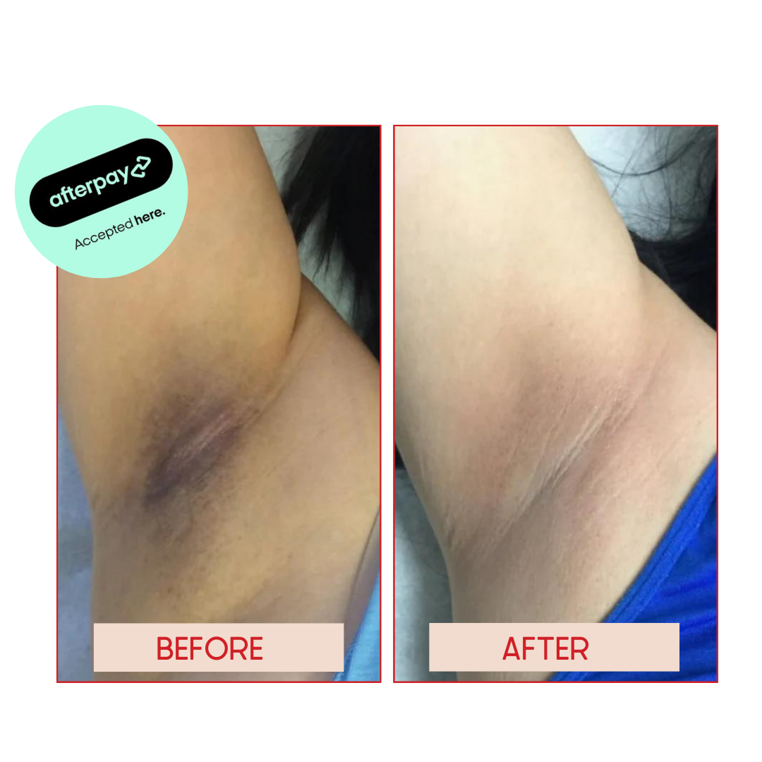 UNDERARM WHITENING SYDNEY