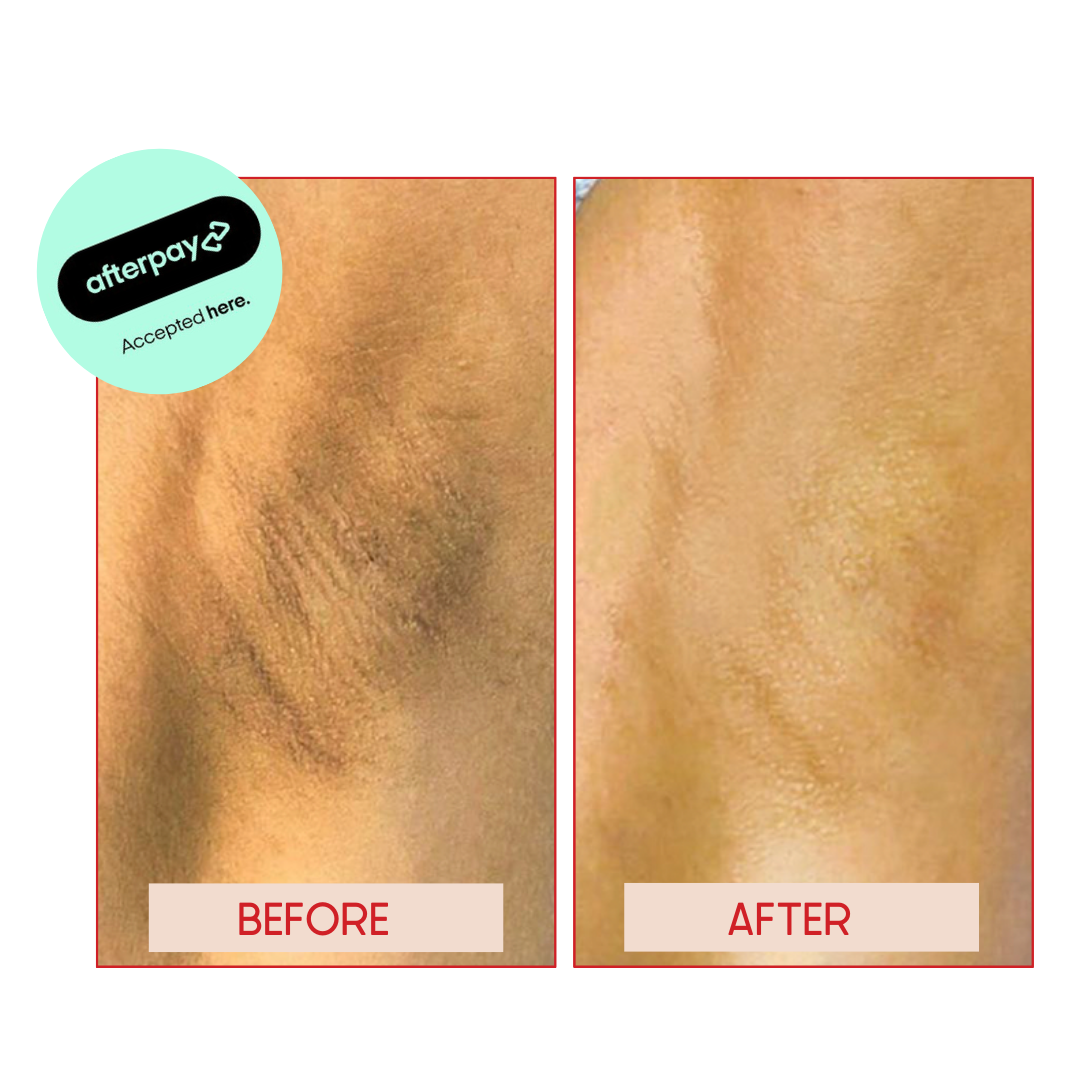 UNDERARM WHITENING near me