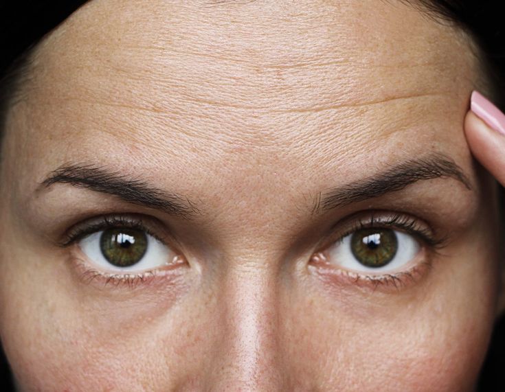 HIFU - Forehead